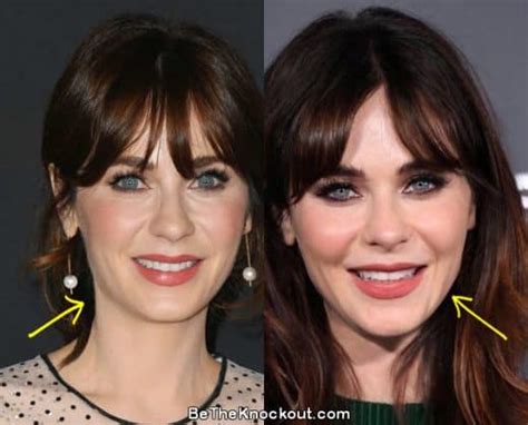 zooey deschanel filler|Zooey Deschanels Plastic Surgery: Nose Job, Lip。